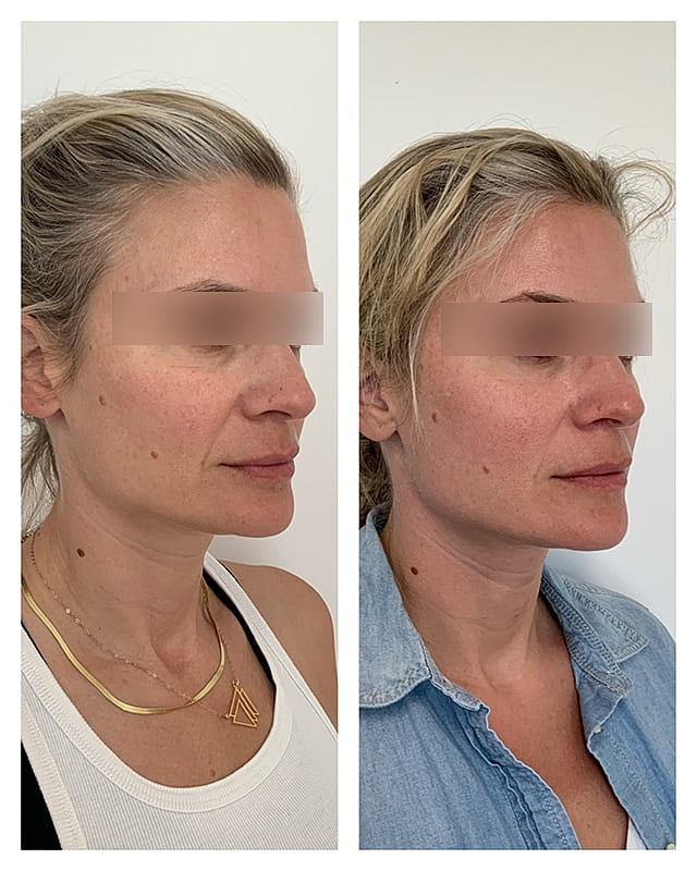 Sculptra Before & After