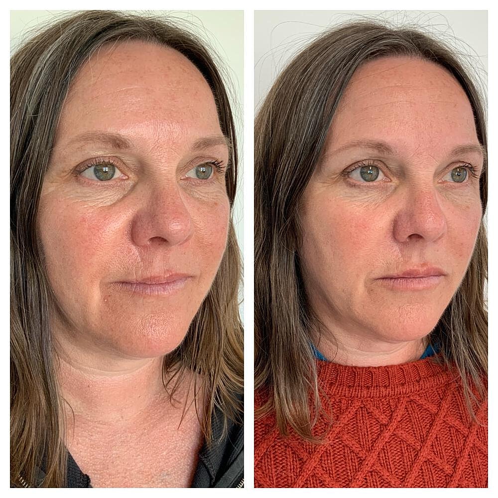 Dermal Filler Before & After