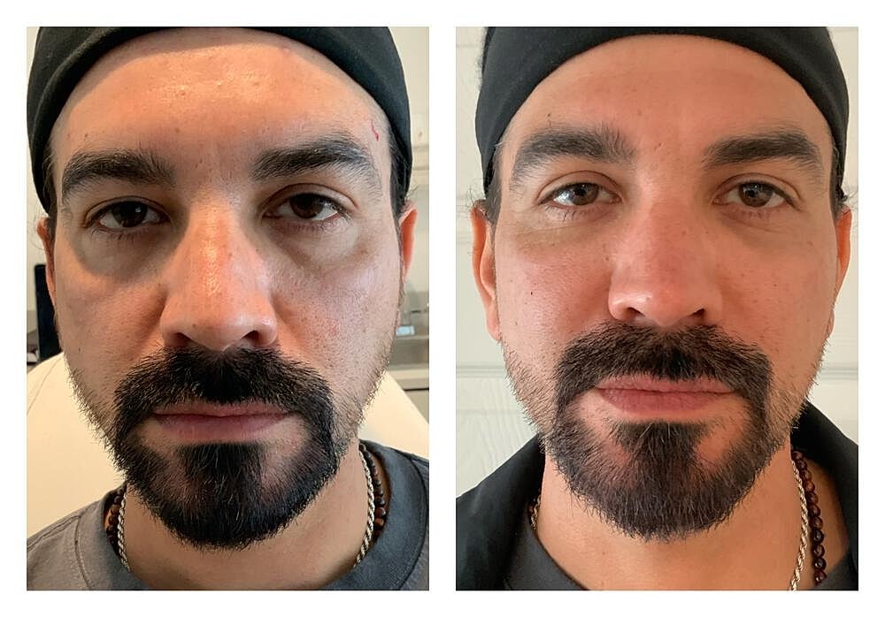 Dermal Filler Before & After
