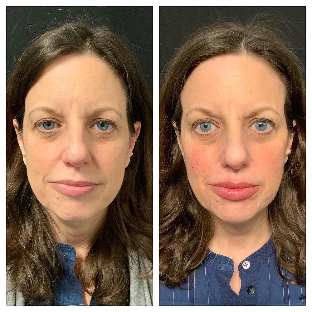 Dermal Filler Before & After