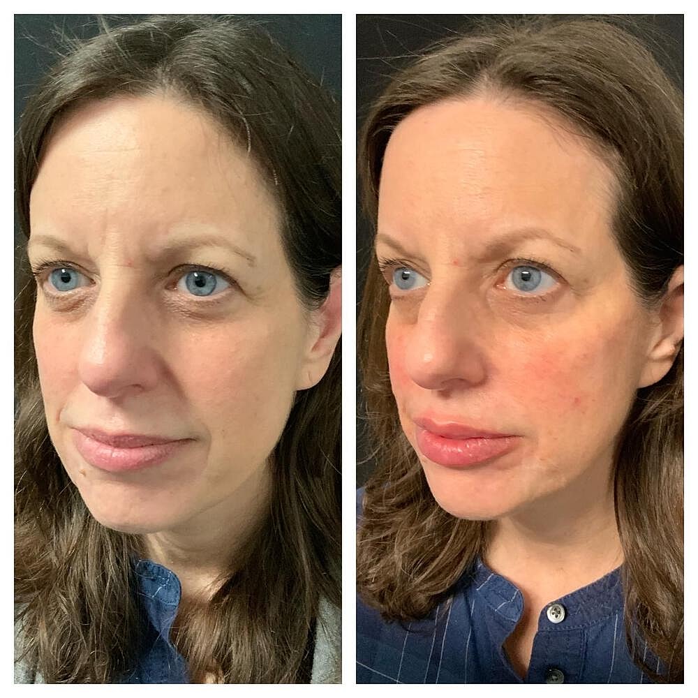 Dermal Filler Before & After