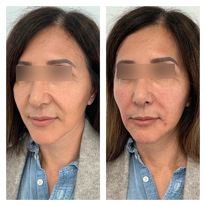Dermal Filler Before & After